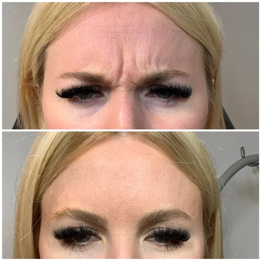 Botox · brows, before and after