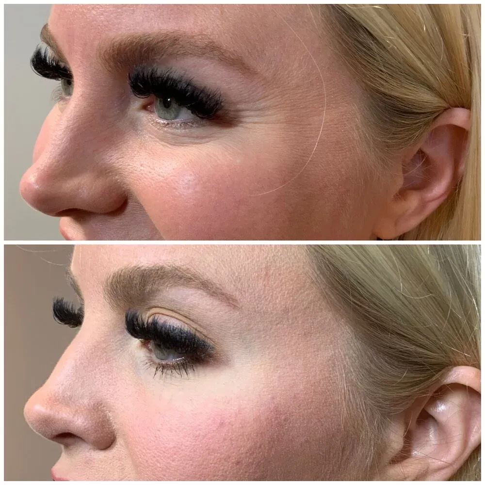 Botox · crow’s feet, before and after