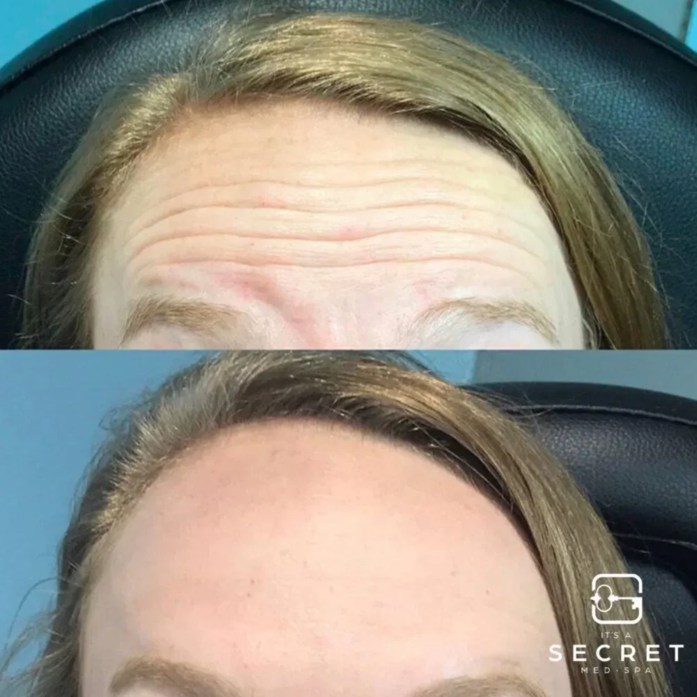 Botox · forehead, before and after