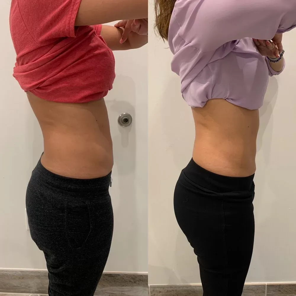 CoolSculpting · abdomen, before and after