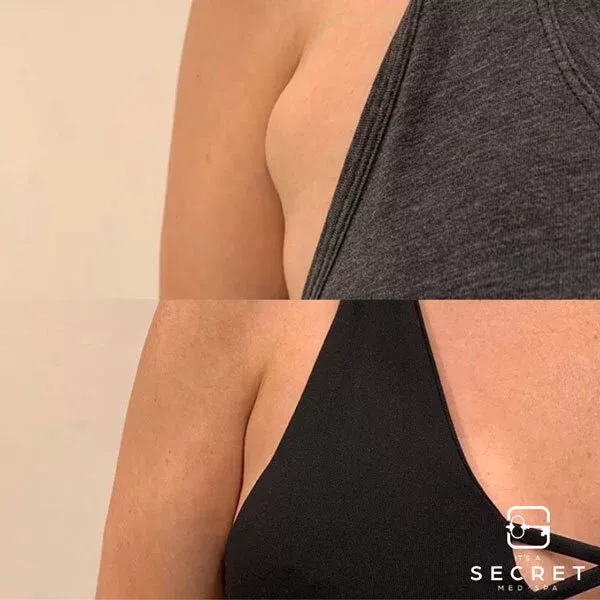 CoolSculpting · underarm area, before and after