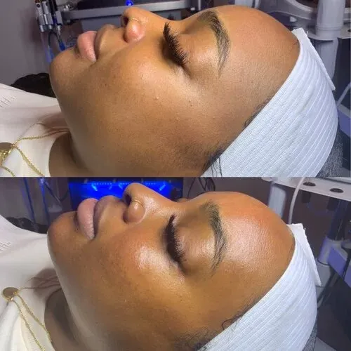 HydraFacial, before and after